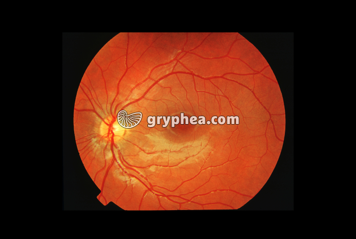 Fond de rétine d'un enfant de 12 ans - gryphea.org